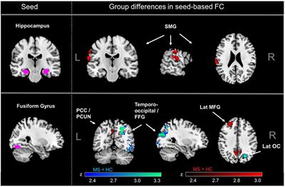 Distinct Functional Connectivity Signatures of Impaired Social Cognition in Multiple Sclerosis